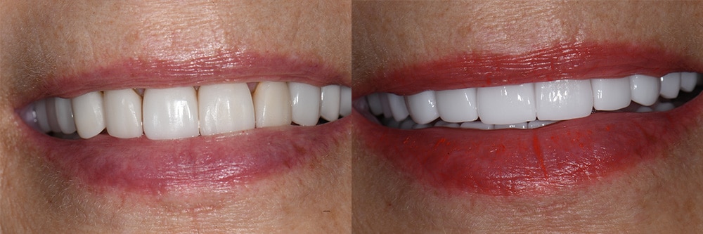 2026 june patient before after