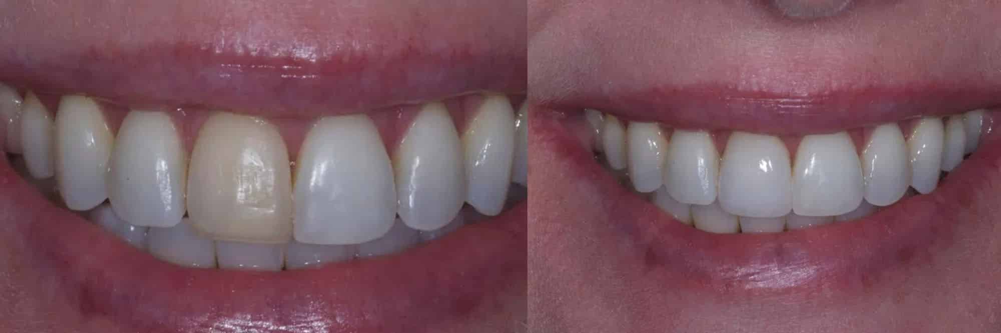 Before After-6